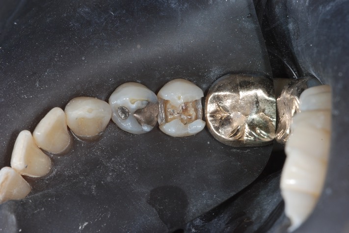 Matt Dodson #20 amalgam removal