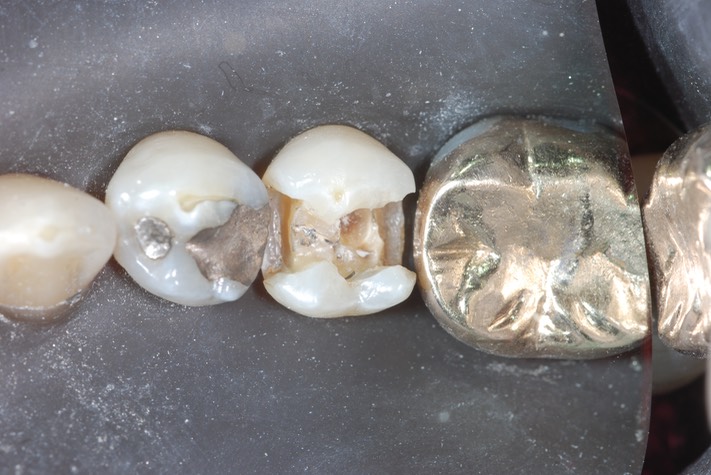 Matt Dodson #20 caries removal