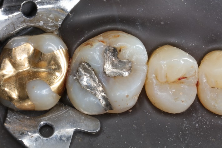 Frank Fukuda #14 pre-op