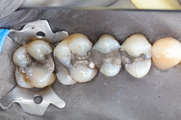 Frank Fukuda #15 pre-op