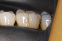 Frank Fukuda #19 buccal amalgam removal