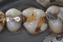 Frank Fukuda #3 amalgam removal