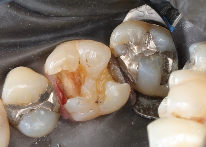 Frank Fukuda #3 caries removal 