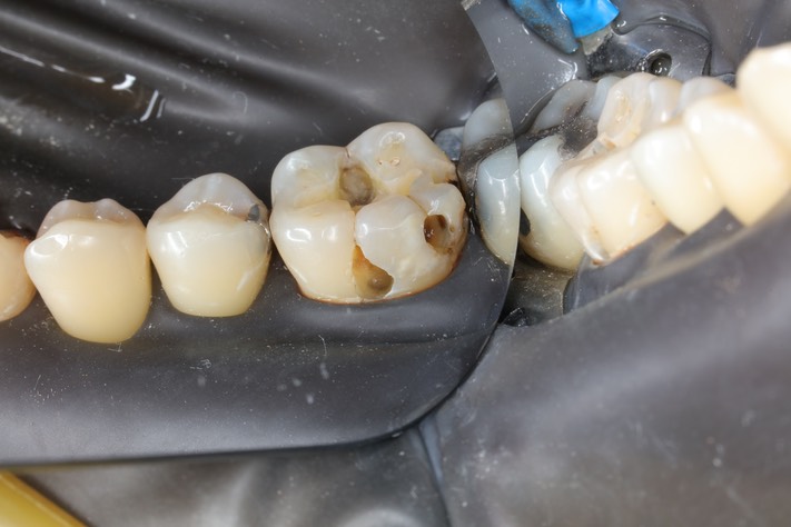 Frank Fukuda #30 amalgam removal buccal