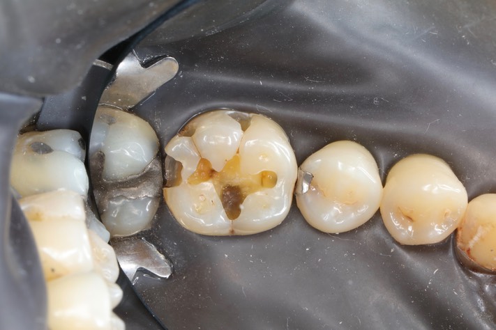 Frank Fukuda #30 amalgam removal