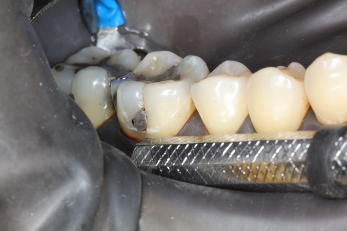 Frank Fukuda #30 pre-op buccal