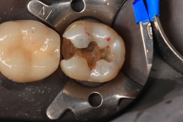 Frank Fukuda #18 caries removal