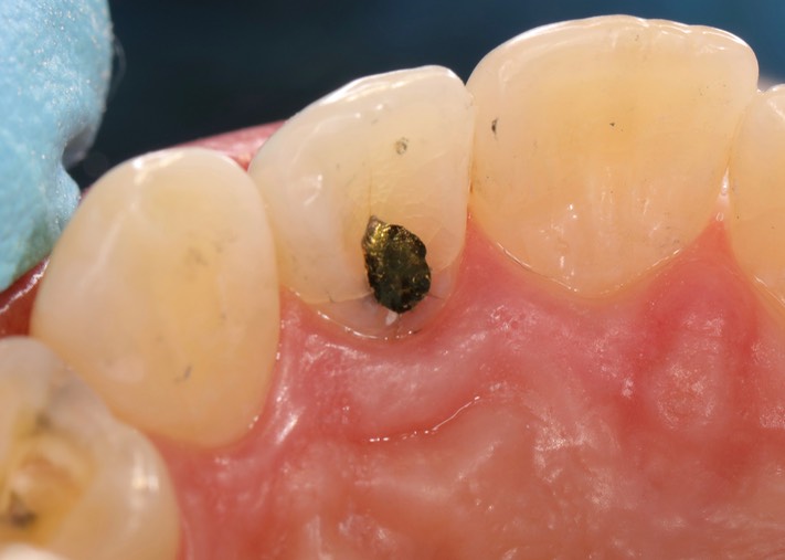 Gary Umeda #10 foil finish