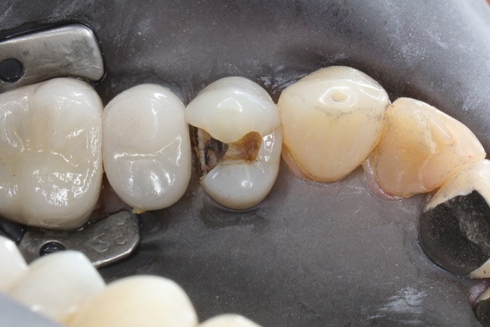 Gary Umeda #12 vertical fracture