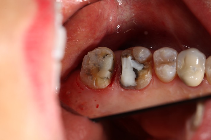 Gary Umeda #14-15 prep