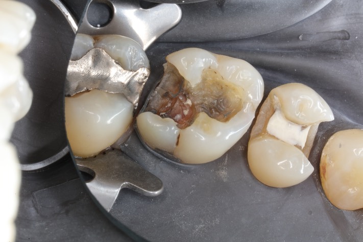 Gary Umeda #14 caries removal