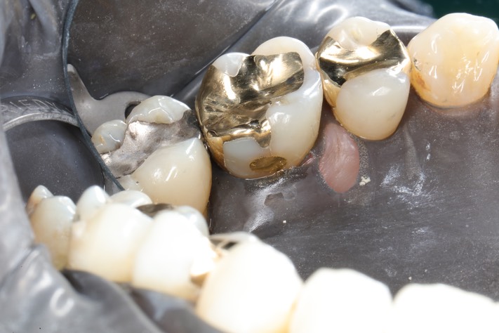 Gary Umeda #14 lingual foil