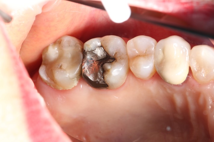 Gary Umeda #14 pre-op