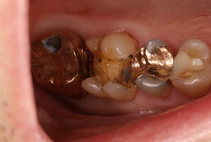 Gary Umeda #2-3 pre-op