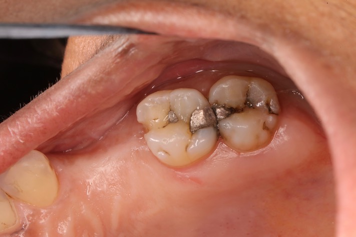 Gary Umeda #2-3 pre-op