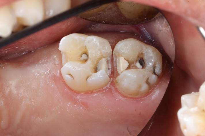 Gary Umeda #2-3 prep