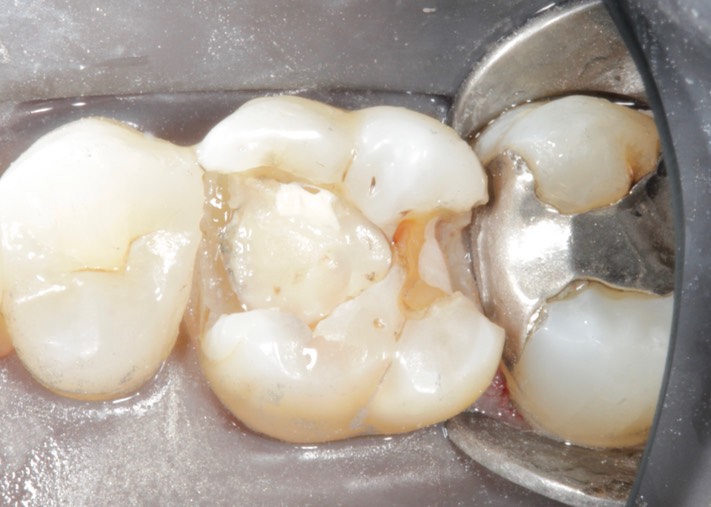 Gary Umeda #3 caries removal