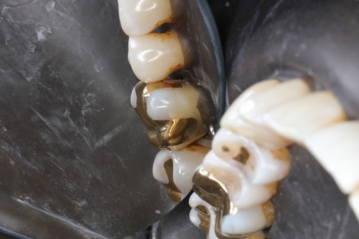 Gary Umeda #3 finish buccal view