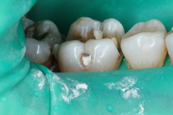 Gary Umeda #30 buccal prep