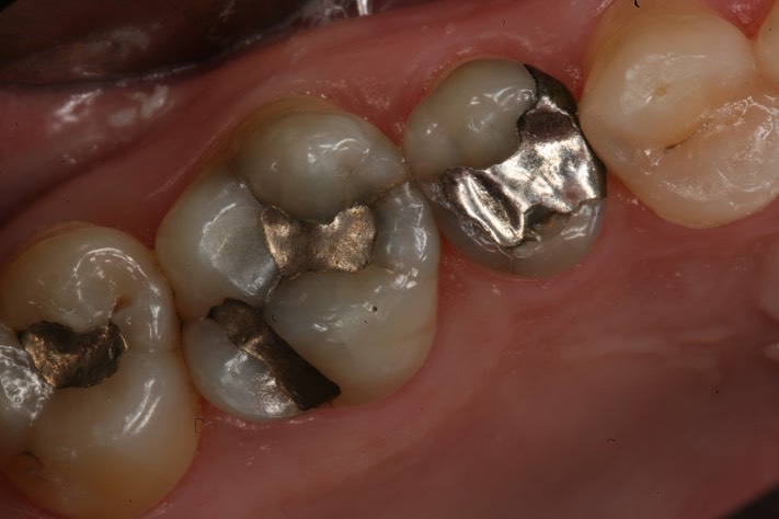 Gary Umeda #13-14 pre-op