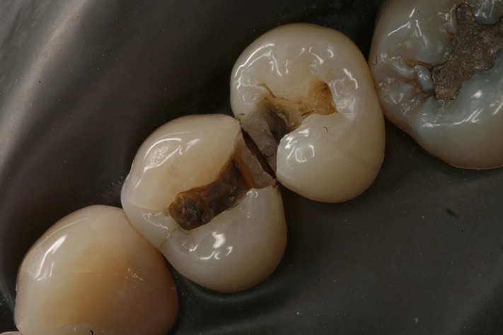 Kyle Chock #4-5 caries removal