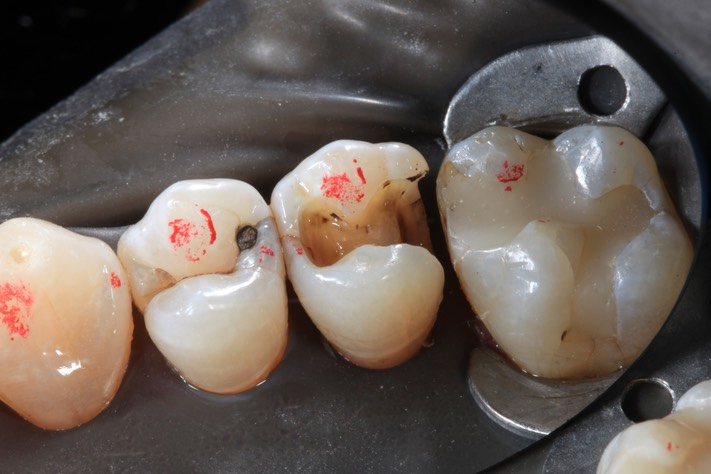 Frank Fukuda #4 amalgam removal