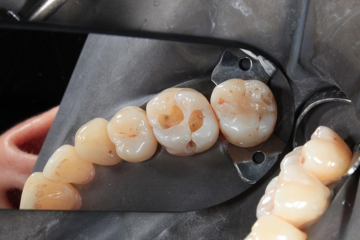 Chris Woo #3 composite removal