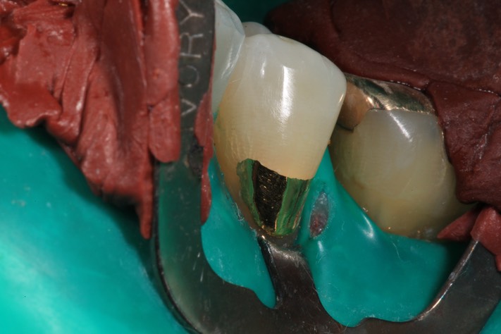 Ted Kanamori #20 finish - mesial