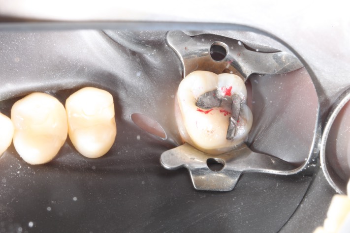 Kyle Chock #2 pre-op