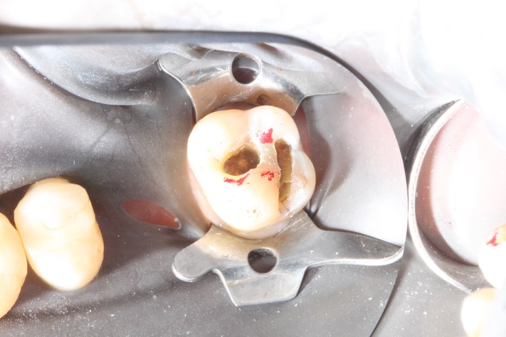 Kyle Chock #2 amalgam removal