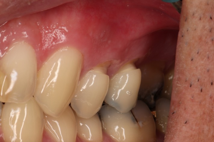 Gary Umeda #12 pre-op