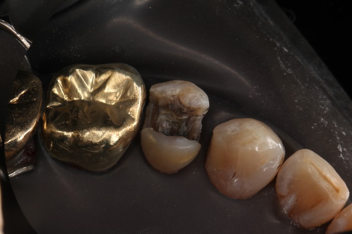 Brian Sato #13 amalgam removal