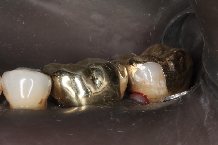 Alan Tamashiro #18 buccal view