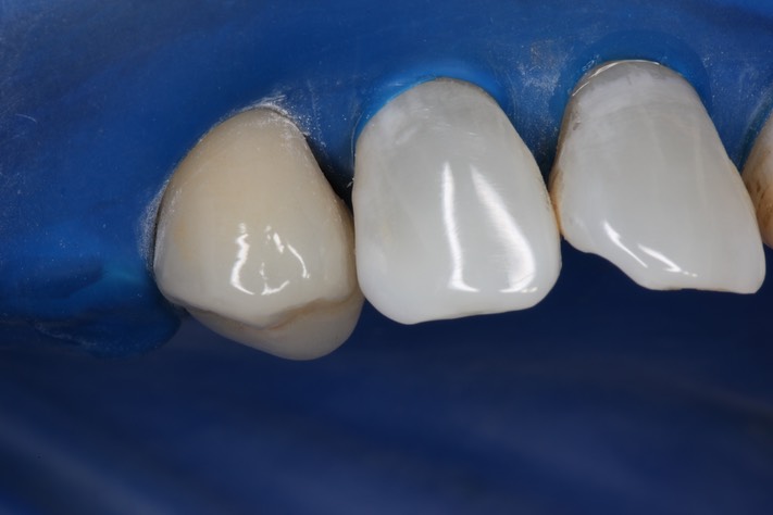 Mark Chun #6 labial view