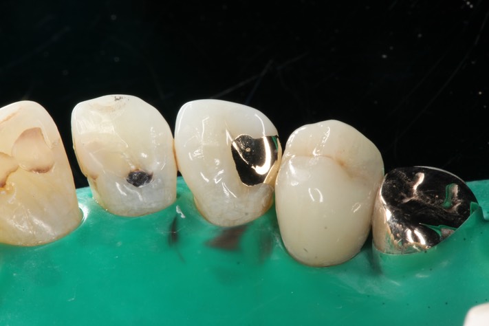 Mark Chun #6 cementation