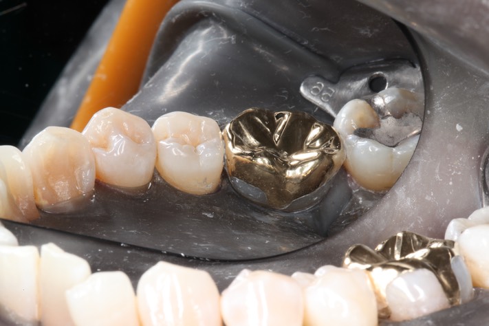 Frank Fukuda #19 lingual view