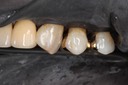 Alan Chinn #12 finish - buccal view