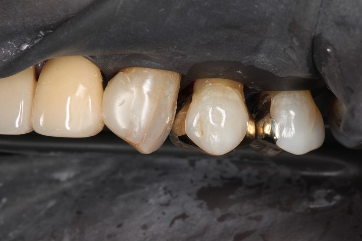 Alan Chinn #12 finish - buccal view