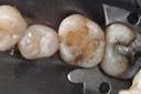 Russ Tabata #3 amalgam removal