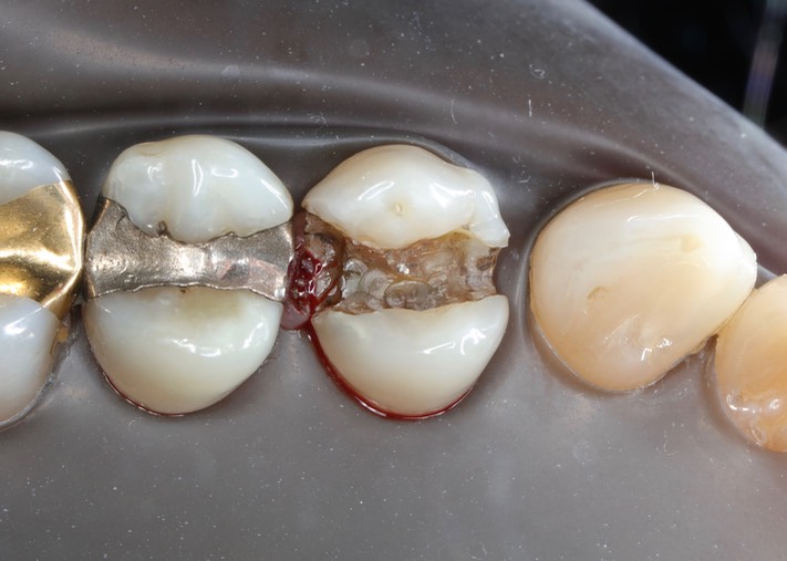 Joe Cha #12 amalgam removal