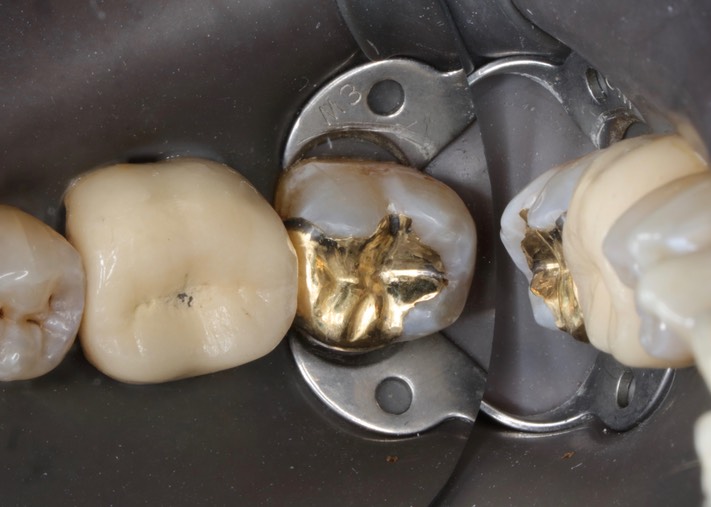 Joe Cha #18 pre-cementation