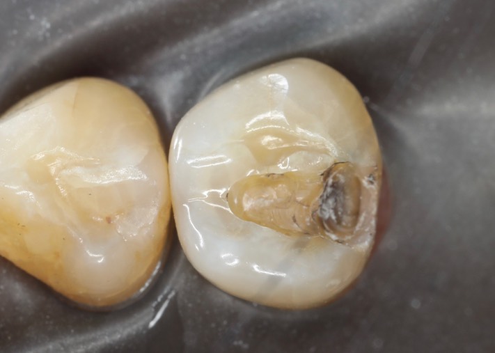 Joe Cha #20 amalgam removal