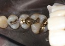 Joe Cha #3 caries removal