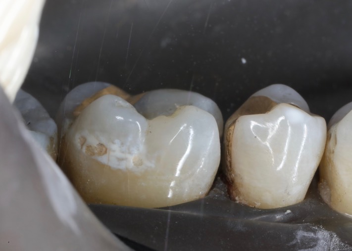 Joe Cha #3 prep buccal view