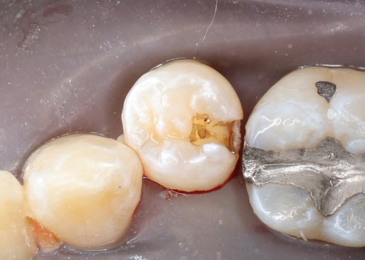 Kris  Nip #21 amalgam removal