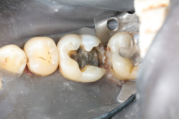 Kris Nip #19 amalgam removal