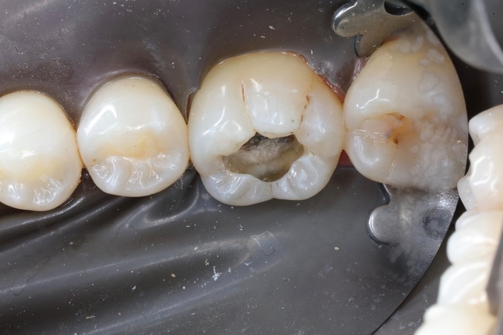 Kris Nip #19 caries removal