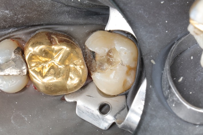 Kris Nip #2 caries removal