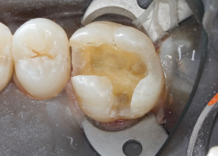 Kris Nip #3 composite removal