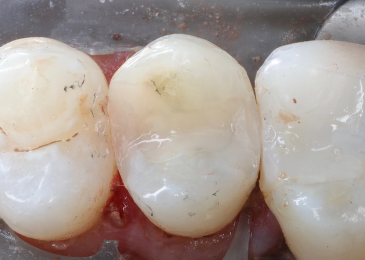 Kris NIp #4 temporary composite